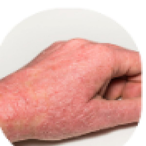 Eczema
