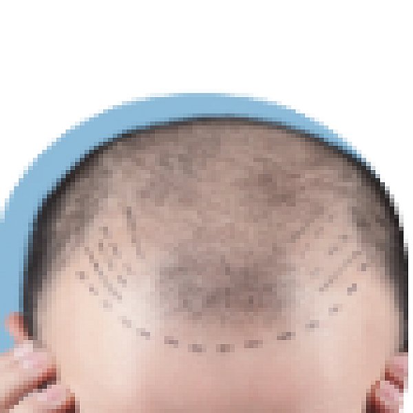 Hair Fall