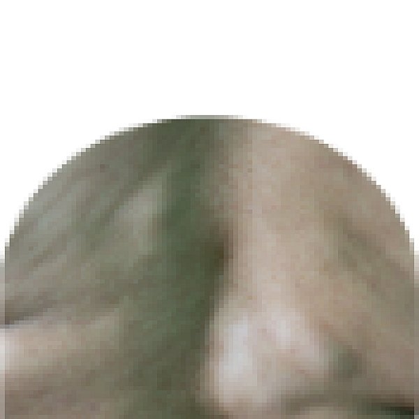 Lipoma